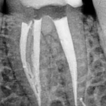 Cazuri variate de molari mandibulari