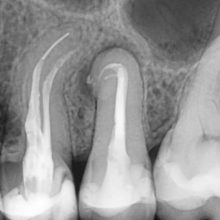 Retratament endodontic premolar maxilar cu curbura severa.