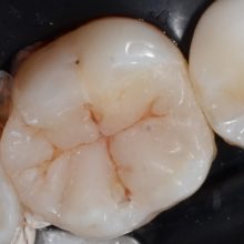 Restauratii compozite estetice si morfofunctionale molar si premolar mandibular