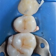 Restauratii compozite directe premolar si molar maxilar cu refacerea formei estetice naturale si a functiei.