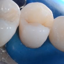 Restauratie compozita morfofunctionala pe un pemolar maxilar dupa tratament endodontic.