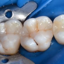 Restauratii morfofunctionale molari maxilari cu refacerea anatomiei cat mai natural si functional.